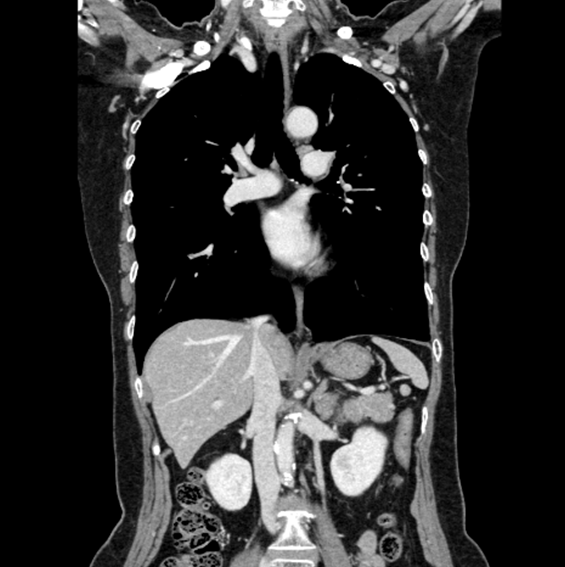 胸部～上腹部造影CT冠状断画像