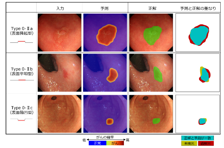 内視鏡検査画像に対する専門医の範囲診断とAIによる領域予測の比較