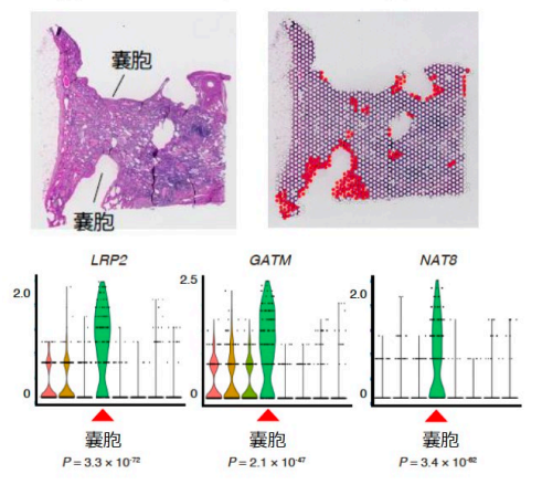 図3 嚢胞壁における近位尿細管特異的遺伝子の発見の画像