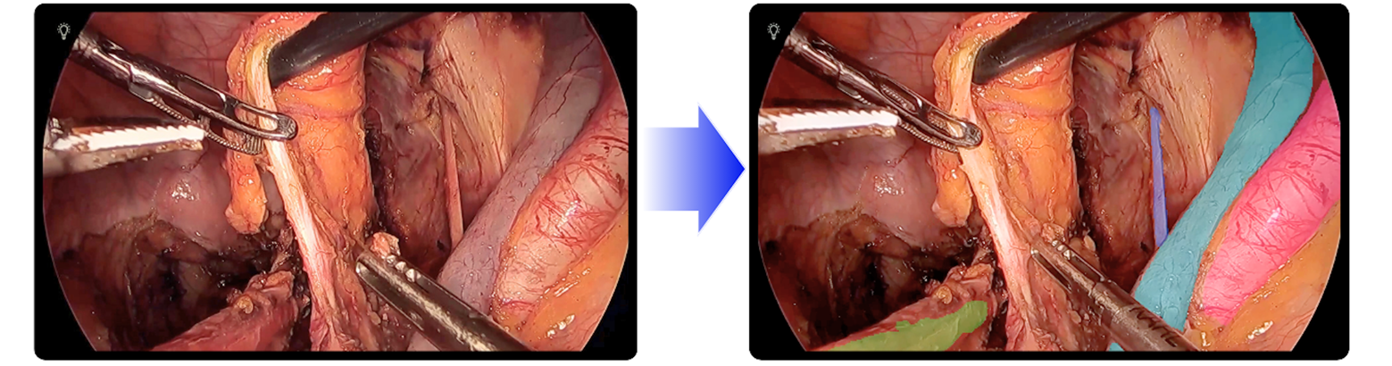 Jmeesと国立がん研究センター東病院が共同開発した「内視鏡手術支援プログラム_SurVis-Pel」が薬事承認を取得