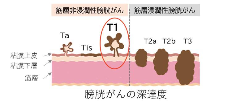完全切除後のT1膀胱がんに対して無治療経過観察が標準治療の一つとなることを証明～JCOGによる研究成果～
