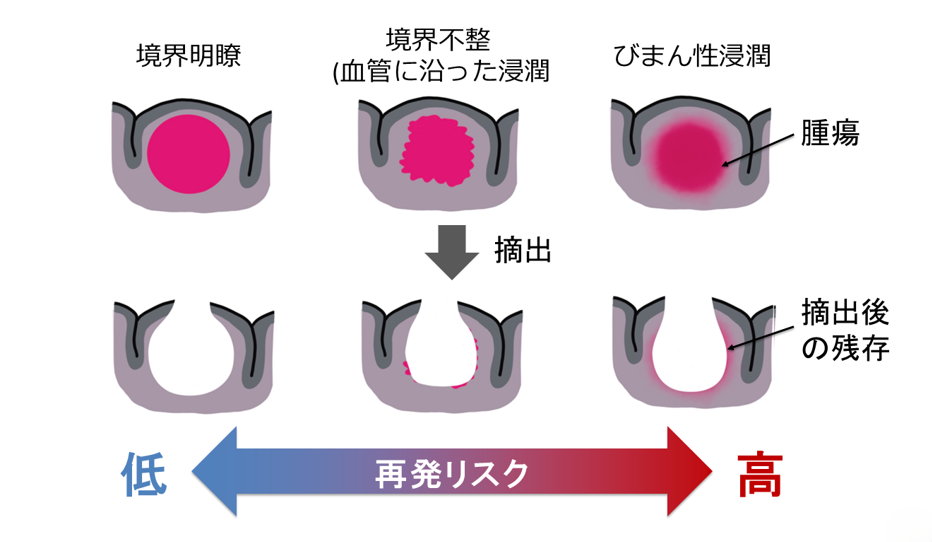 転移性脳腫瘍に対する光線力学的療法の有効性を評価する第II相臨床試験を先進医療Bで開始～治療法が限られた転移性脳腫瘍に対して選択肢の拡充を目指す～