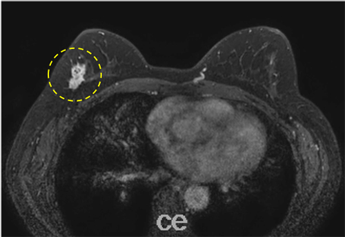 造影 ct で 見つかる 乳がん