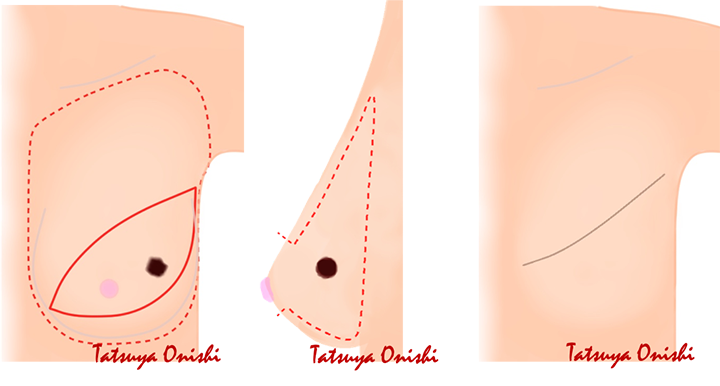 乳がんの手術について 国立がん研究センター 東病院