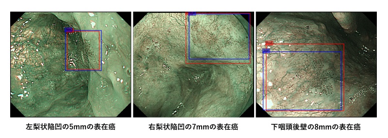 咽喉頭表在がんAI-図１