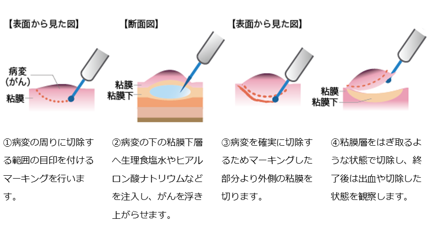 図2内視鏡的粘膜下層剥離術（ESD）