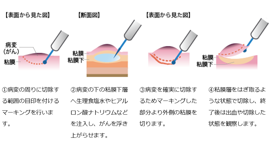 食道がん 国立がん研究センター 東病院