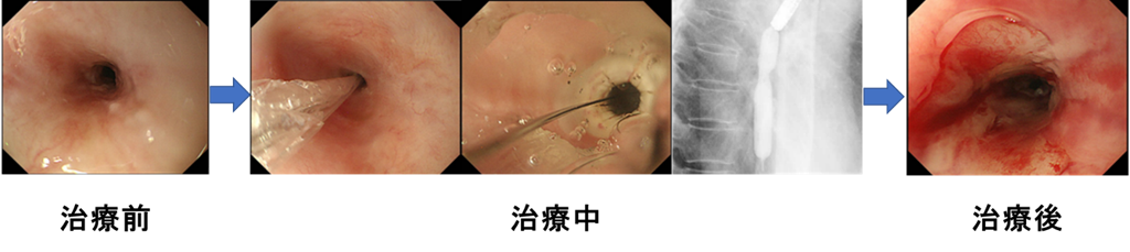図4内視鏡的食道拡張術（EBD）