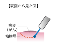 図1-1内視鏡的粘膜下層はく離術（ESD）