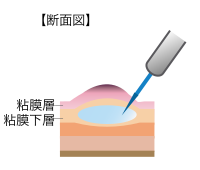 図1-2内視鏡的粘膜下層はく離術（ESD）