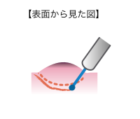 図1-3内視鏡的粘膜下層はく離術（ESD）