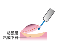 図1-4内視鏡的粘膜下層はく離術（ESD）