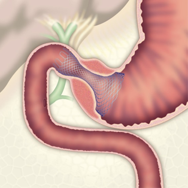 図2-1内視鏡的胃十二指腸ステント留置術