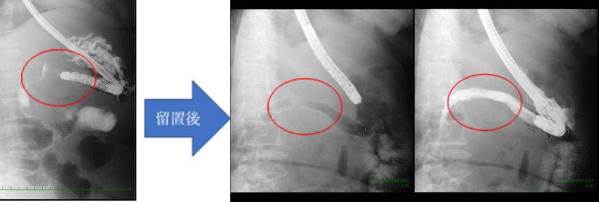 図2-2内視鏡的胃十二指腸ステント留置術