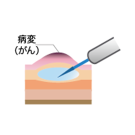 図1-1内視鏡的粘膜切除術(EMR)