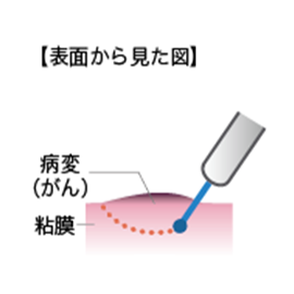 図2-1内視鏡的粘膜下層剥離術(ESD)