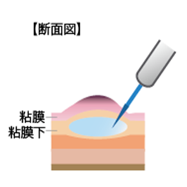 図2-2内視鏡的粘膜下層剥離術(ESD)