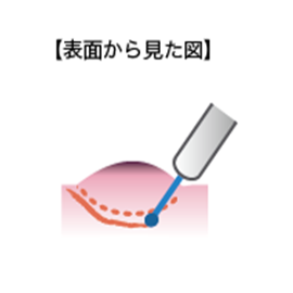 図2-3内視鏡的粘膜下層剥離術(ESD)