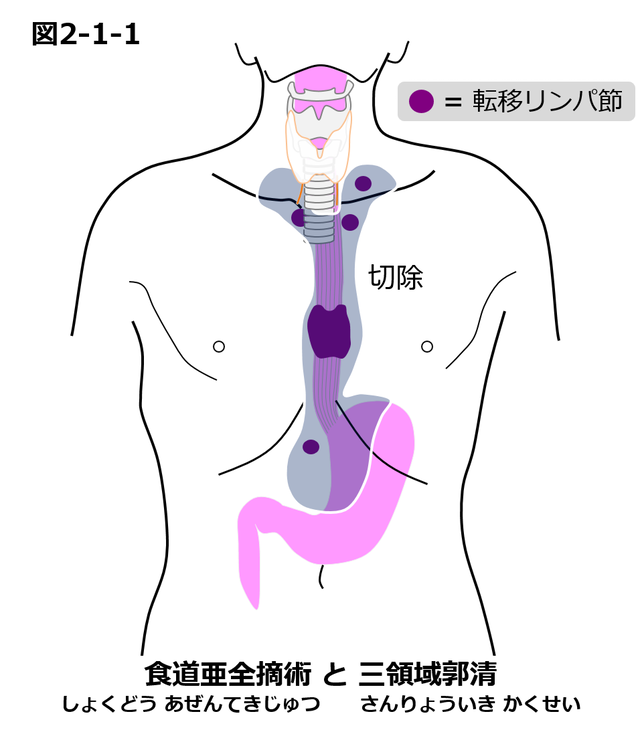 2 道がんの 術治療 国立がん研究センター 東病院