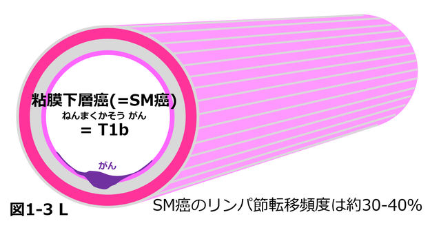 1 道がんとは 国立がん研究センター 東病院