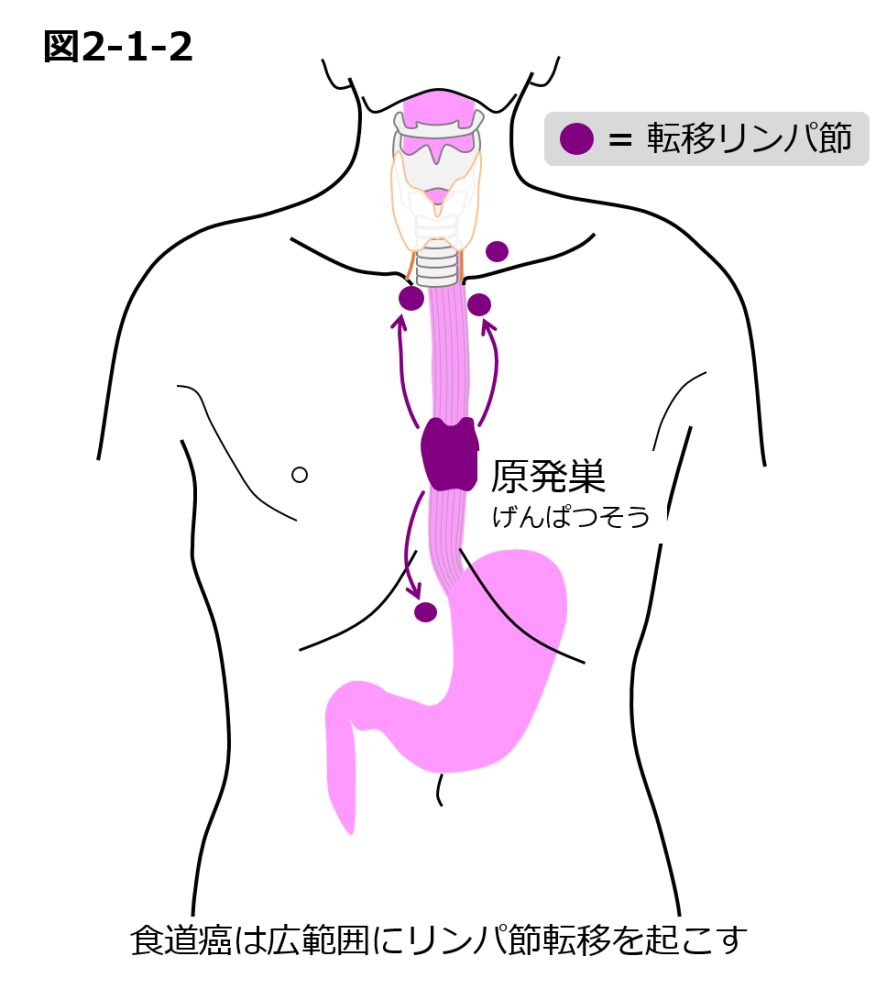 2 道がんの 術治療 国立がん研究センター 東病院