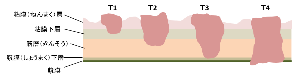胃がんの深さの分類イメージ