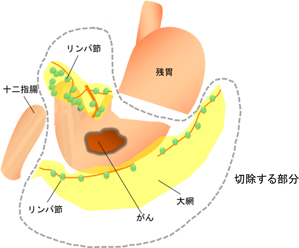 胃がん手術のリンパ節郭清の画像