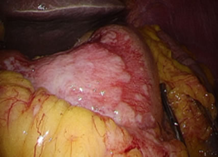 審査腹腔鏡で見た胃がんの画像