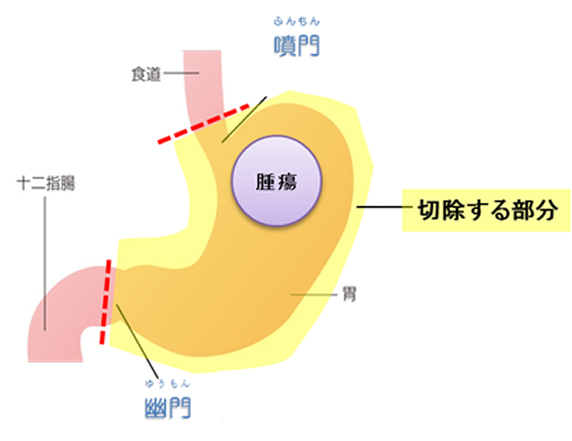 胃がんの手術について 国立がん研究センター 東病院