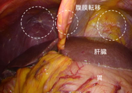 審査腹腔鏡で見た腹膜転移の画像1