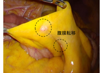 審査腹腔鏡で見た腹膜転移の画像2
