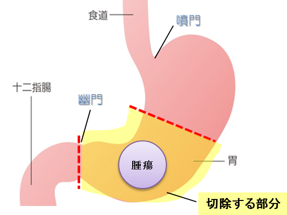 幽門側（ゆうもんそく）胃切除術の画像