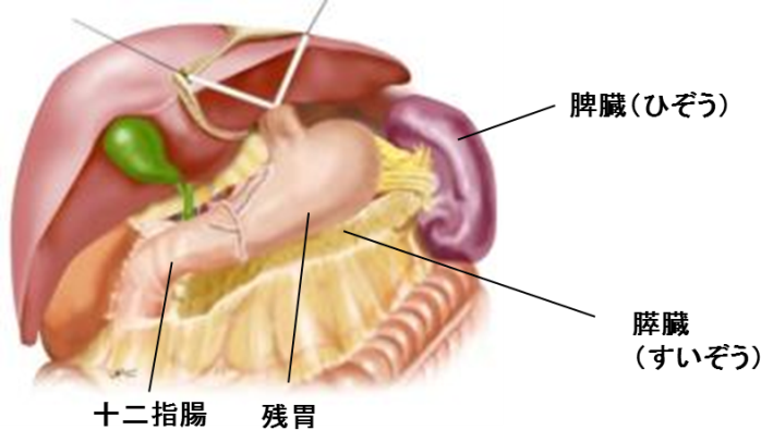 幽門側胃切除術・ビルロートI法再建の画像