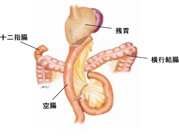 胃がんの手術について 国立がん研究センター 東病院