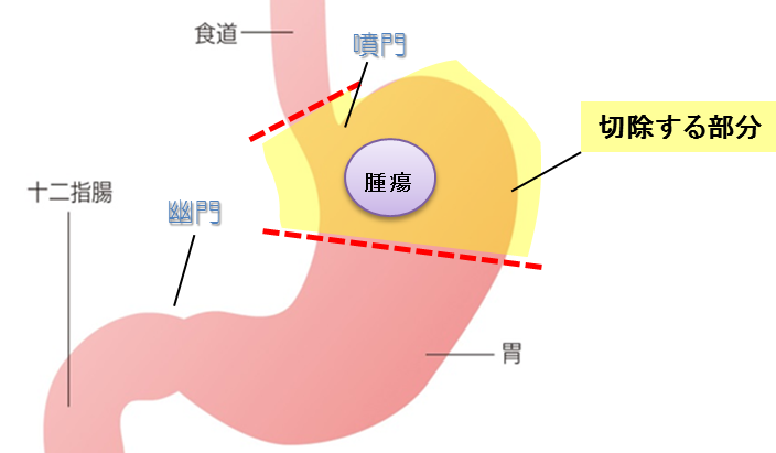 噴門側（ふんもんそく）胃切除の画像