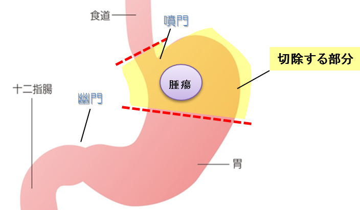 トラクト 法 ダブル