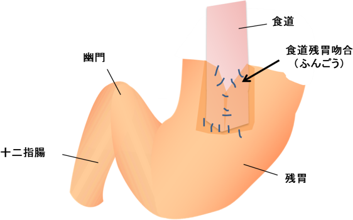 トラクト 法 ダブル