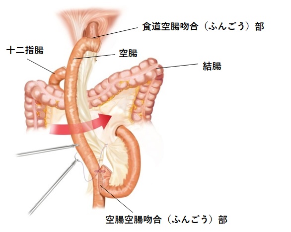 胃全摘術・ルーワイ法再建の画像2