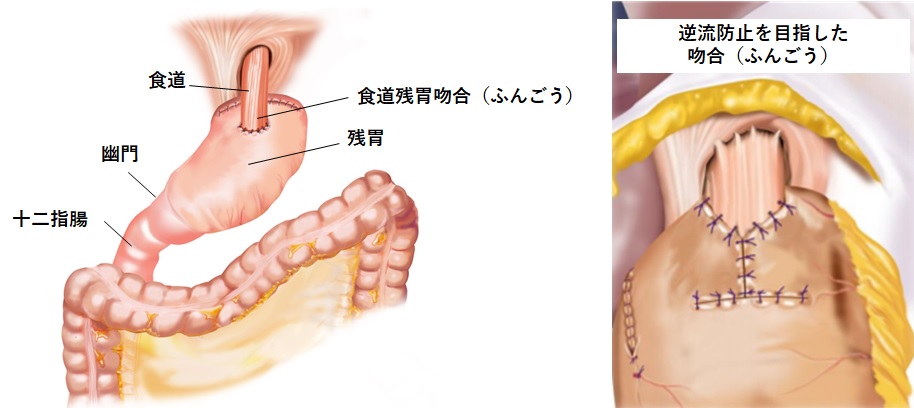 噴門側胃切除・食道残胃吻合の画像