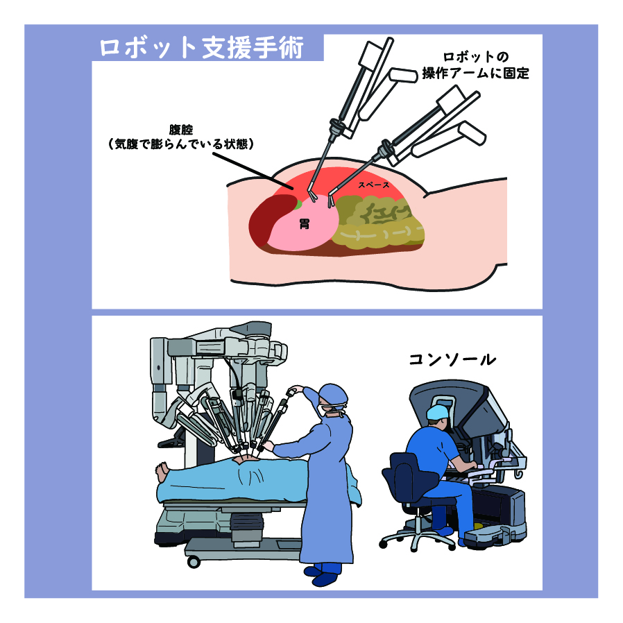 ロボット支援手術