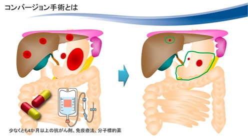 コンバージョン手術のイメージ画像