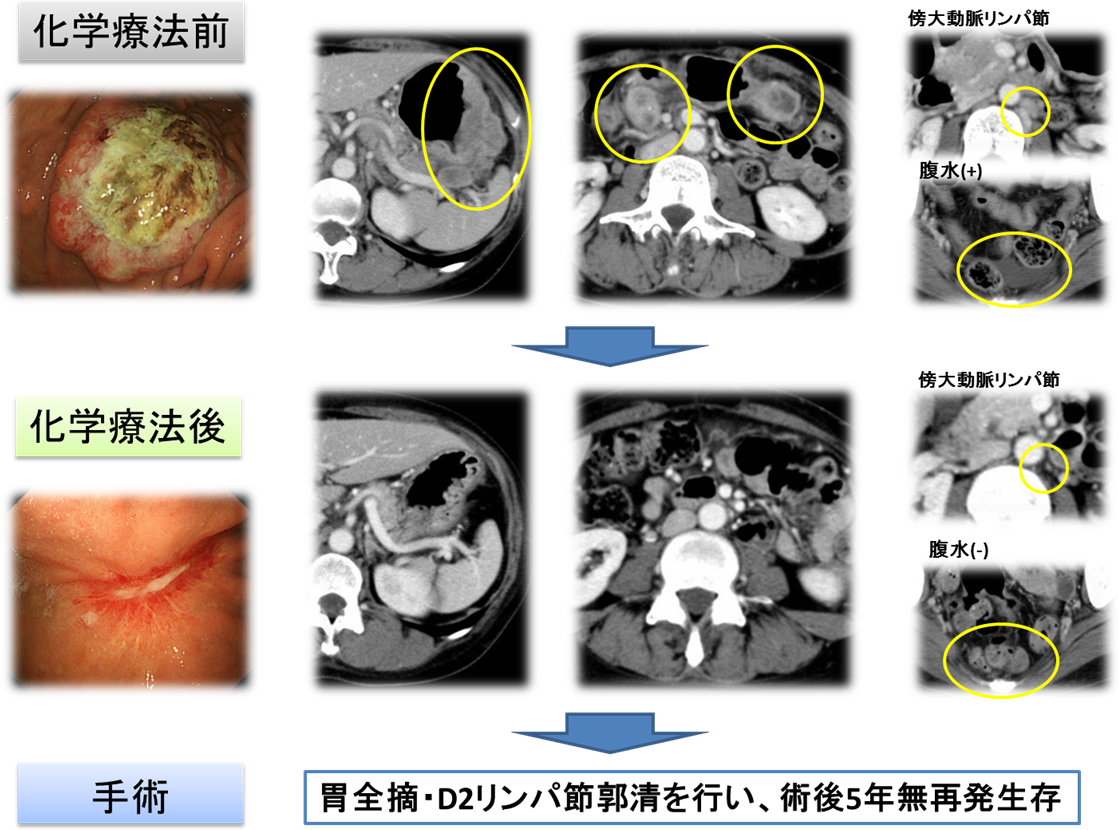 手術が可能となった胃がんの画像