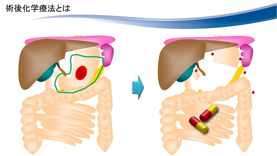術後化学療法のイメージ画像