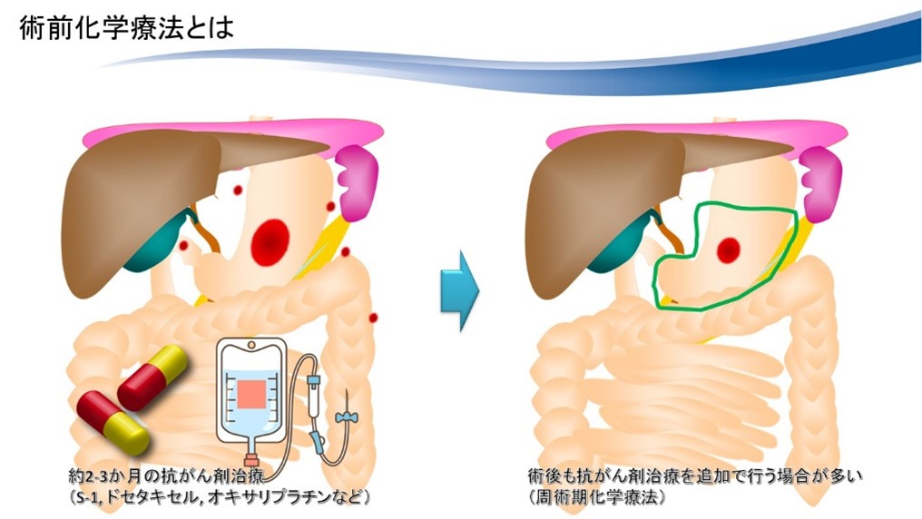 術前化学療法のイメージ画像