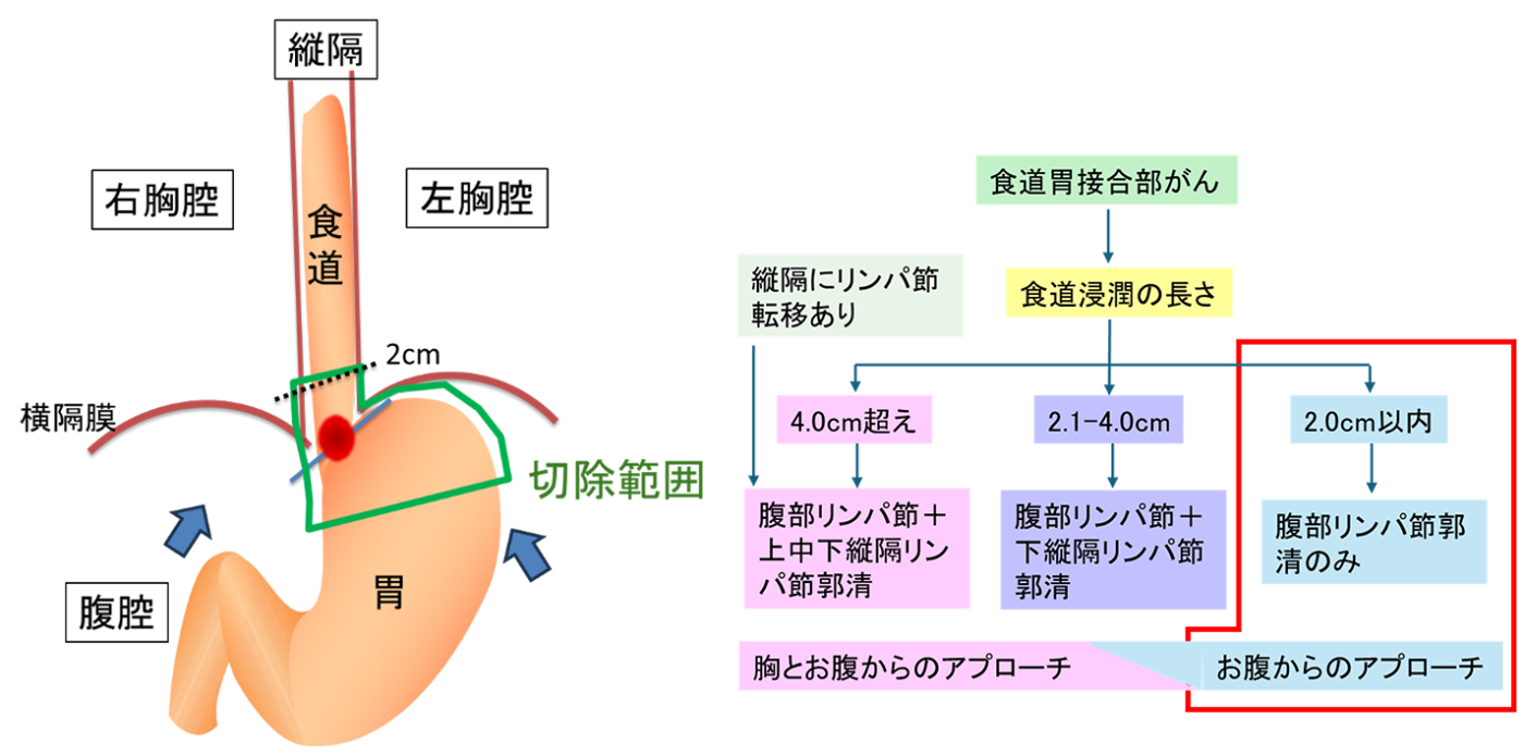 食道側への浸潤が2cm以内の場合の画像
