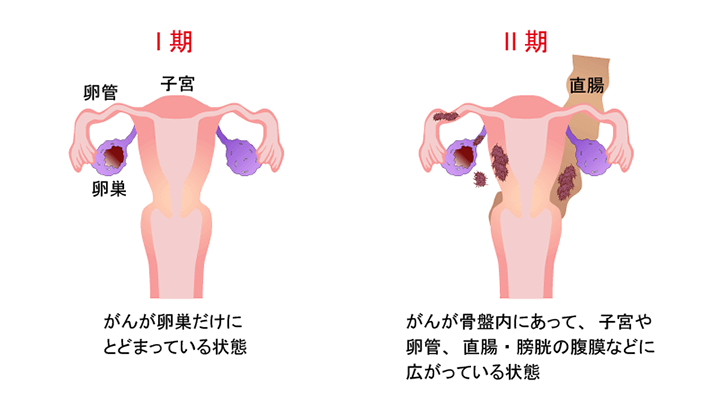 卵巣 が ん の 名医