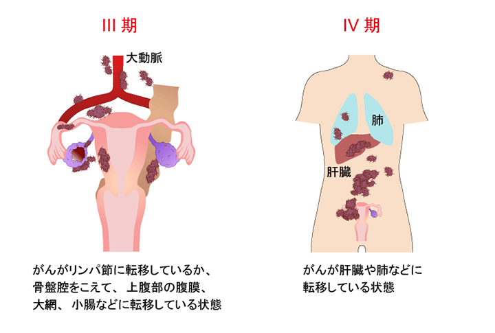 Ovarian5_2