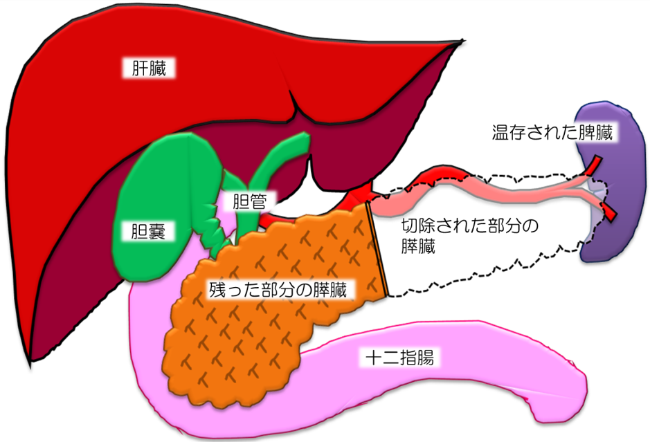 3 悪性度の低いがんに対する機能温存 国立がん研究センター 東病院