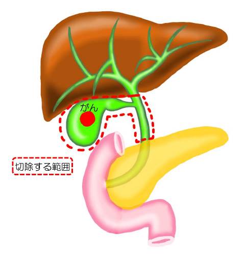 gallbladder_cancer01.jpg