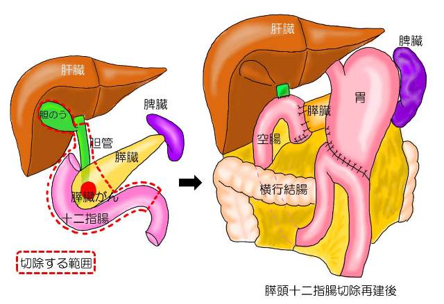 腫瘍 十二指腸 体の奥深く十二指腸がんを取り除く「ハイブリッド手術」